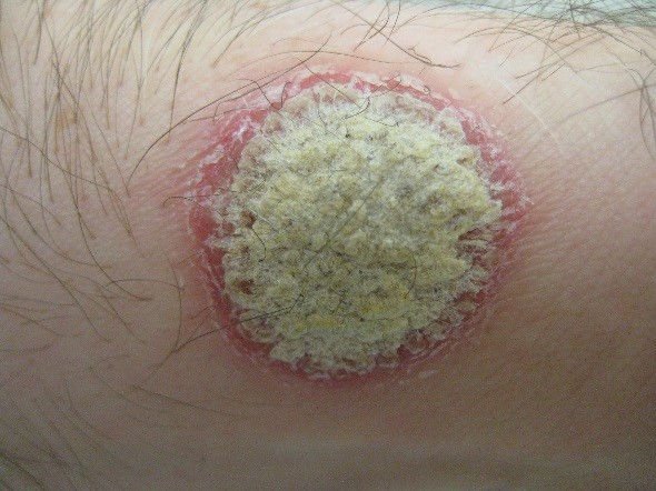What Exactly Is Psoriasis?