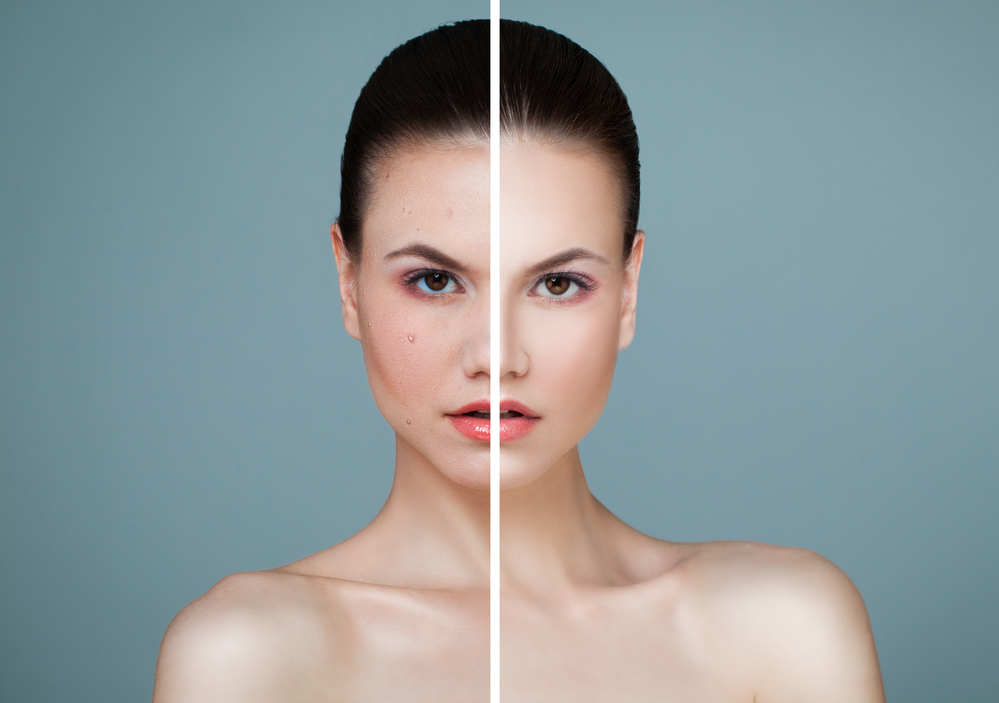 What Happens if Rosacea Is Left Untreated?