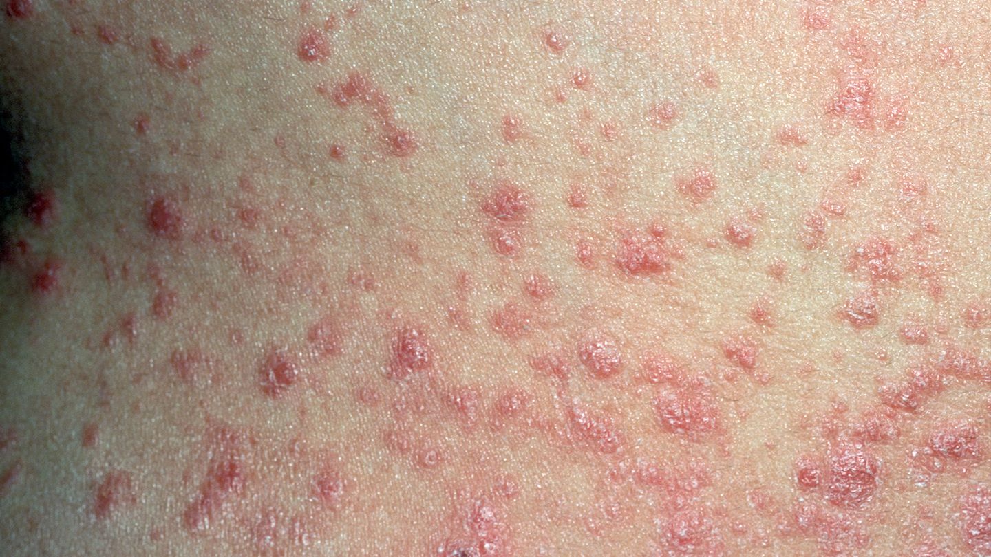 What Is Guttate Psoriasis? Symptoms and Treatment ...