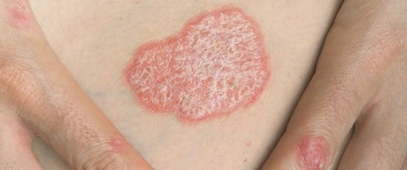What Is Psoriasis And How Can It Be Treated? Doctor Gives ...