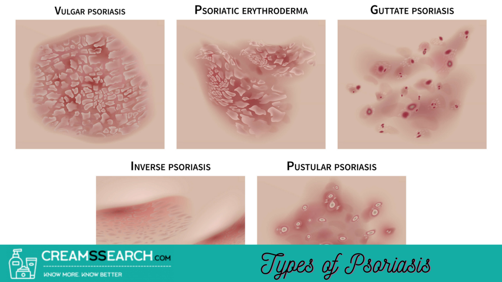 What is Psoriasis, Causes &  Types? Find the Best Psoriasis ...