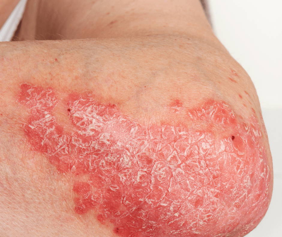 What is Psoriasis? Explained