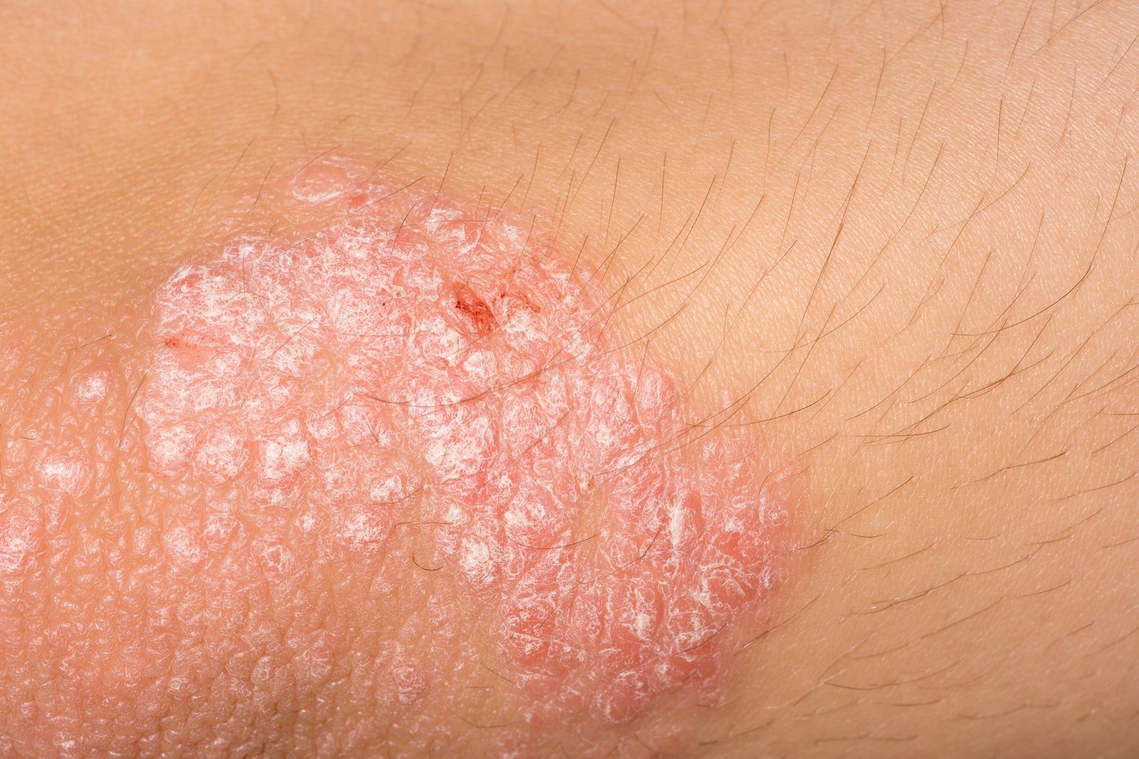 What Is Psoriasis? Signs and Treatment Options ...
