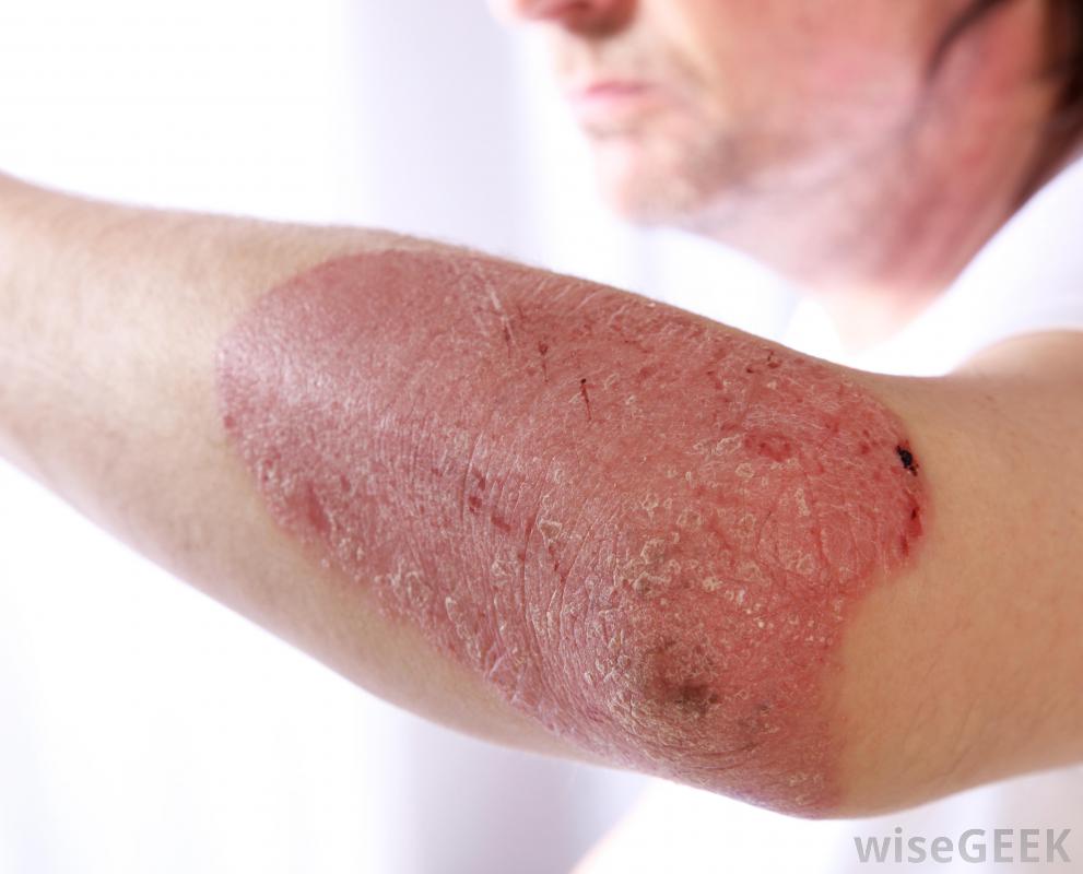 What is Psoriasis? (with pictures)