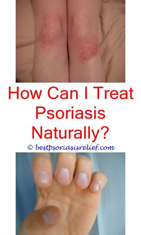 What Is The Best Treatment For Psoriasis On Hands