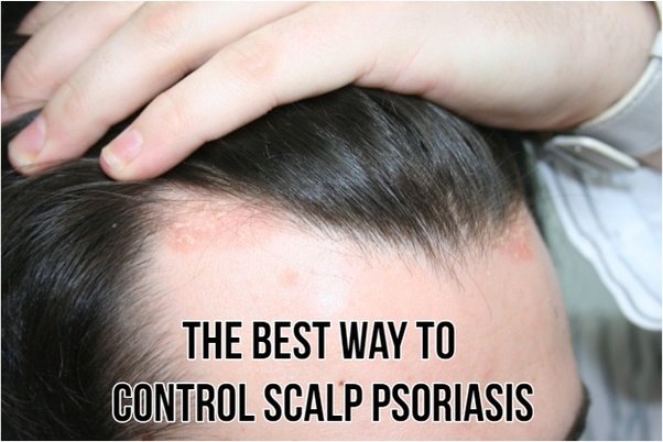What is the best way to control scalp psoriasis?
