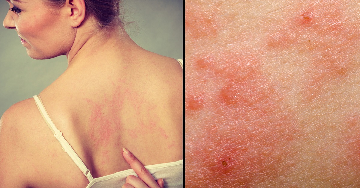 What is the difference between eczema and psoriasis ...