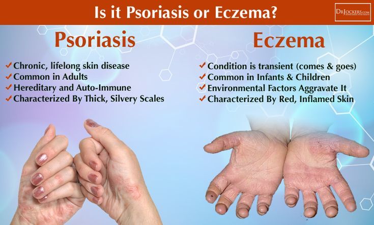 What is the Difference Between Psoriasis and Eczema? # ...