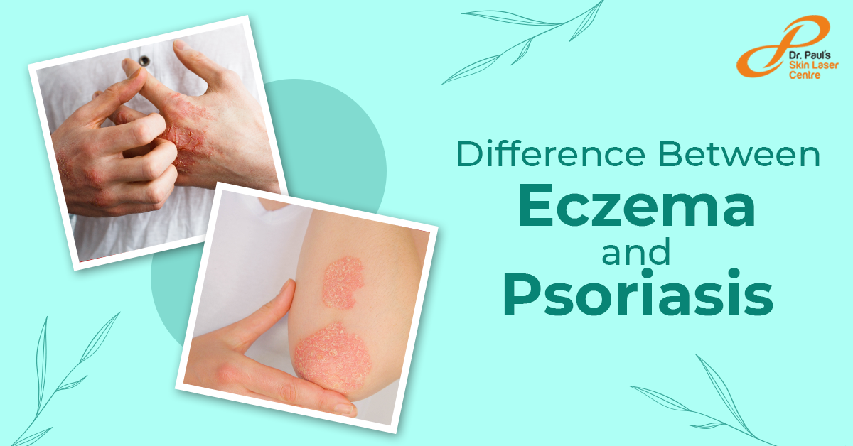 What Is The Difference Between Psoriasis And Eczema