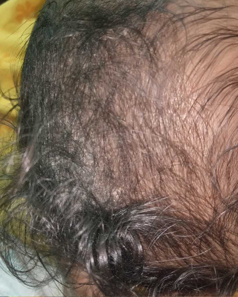 what is this? plz help me. My baby scalp peeling ...