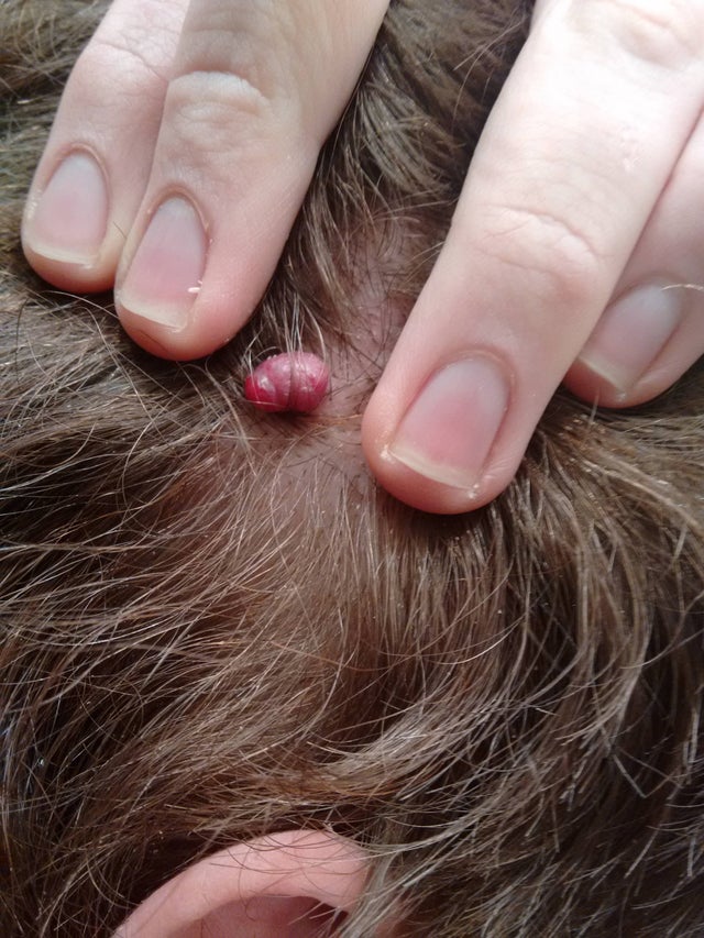 What is this thing on my scalp? : medical