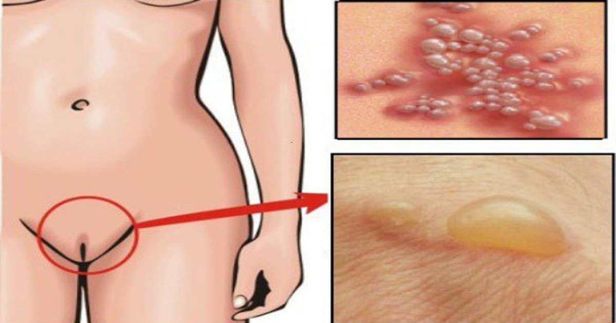 What To Do If You See Blister Or Sores On Your Genitals ...
