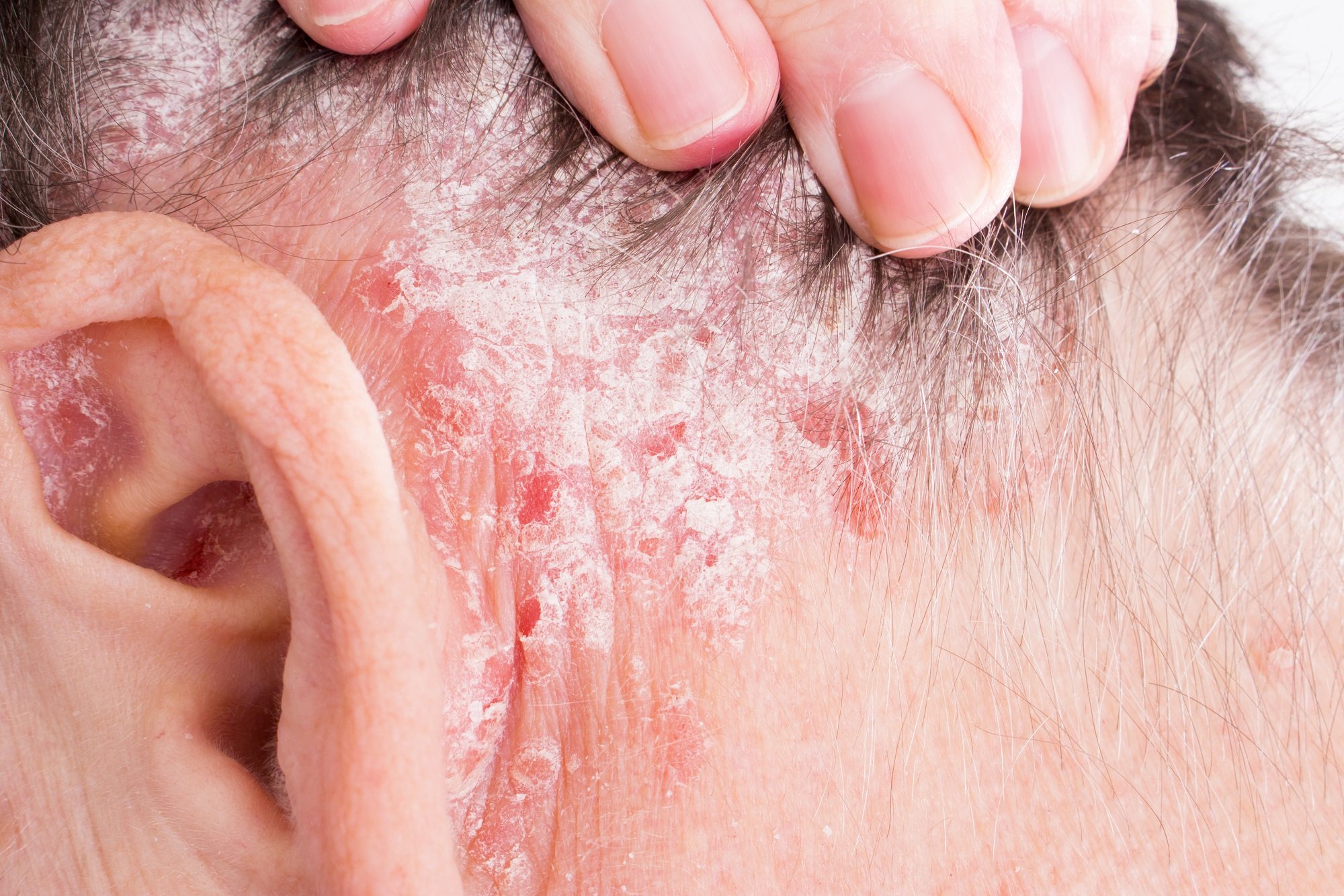 What You Can Do to Help Your Psoriasis Symptoms ...