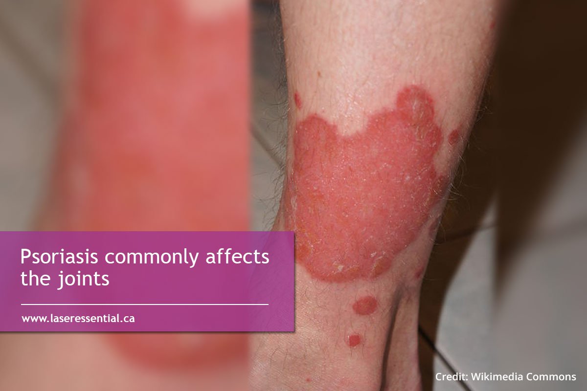 What You Need To Know About Psoriasis