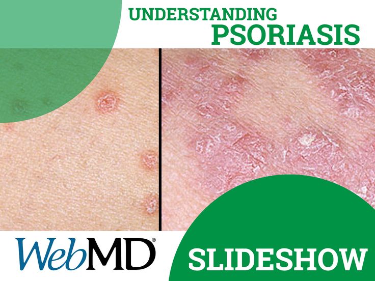 When psoriasis starts, you may see a few red bumps on your skin. These ...