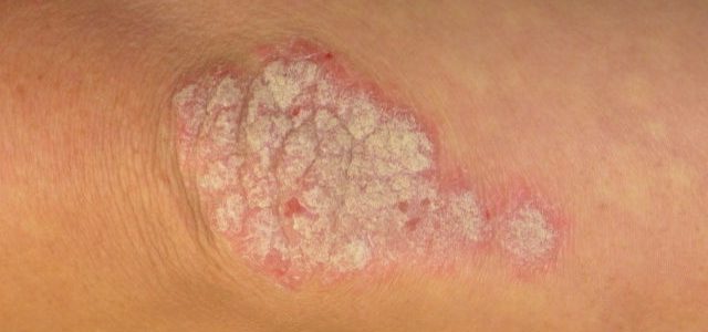 Where Does Psoriasis Come From