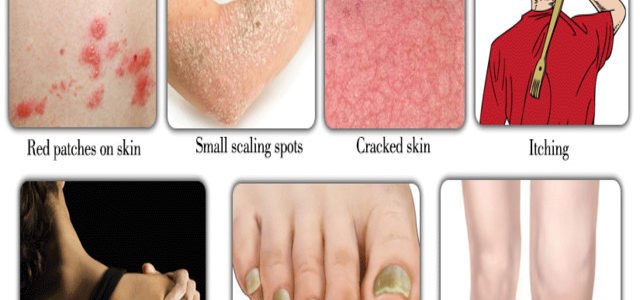 Where Does The Name Psoriasis Come From