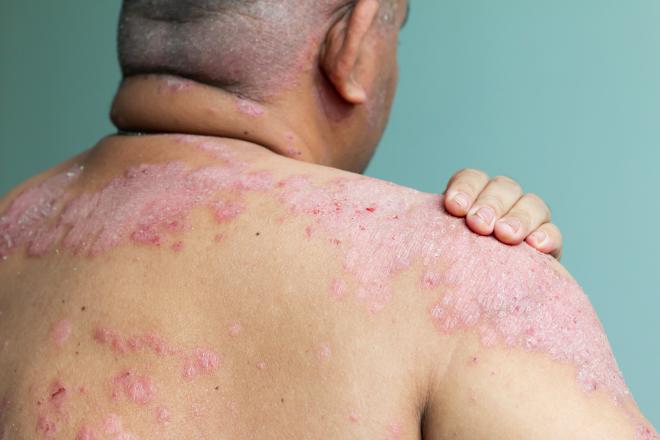 Which Type of Drug Is used to Treat Psoriasis in HIV Patients ...