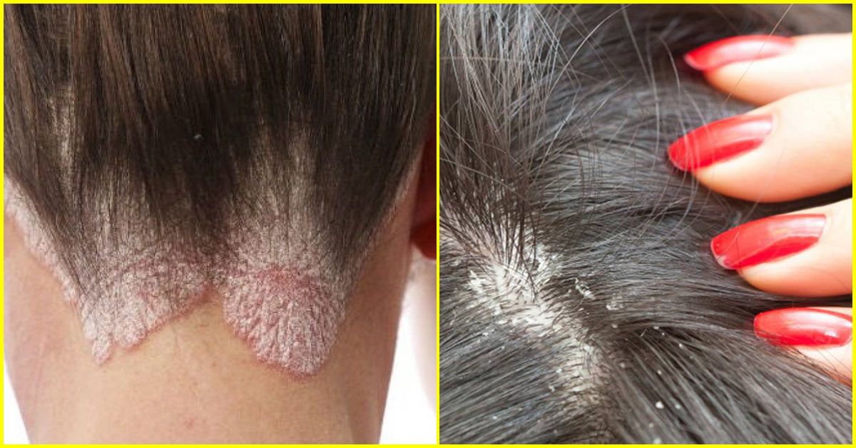 White Flakes In Hair And Itchy Scalp