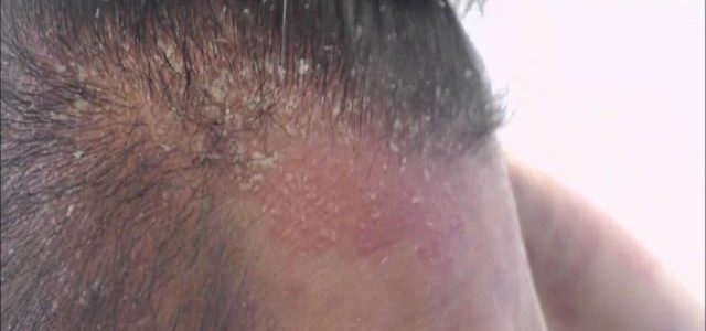 Why Do I Have Psoriasis On The Scalp