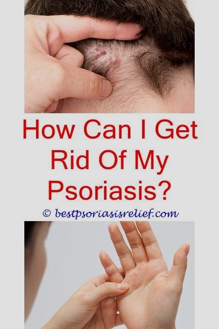 Why Do People Get Psoriasis