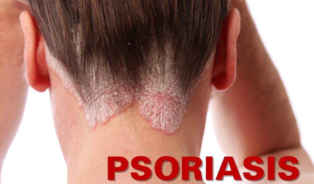Why You Got Psoriasis and How to Get Rid Of It ?