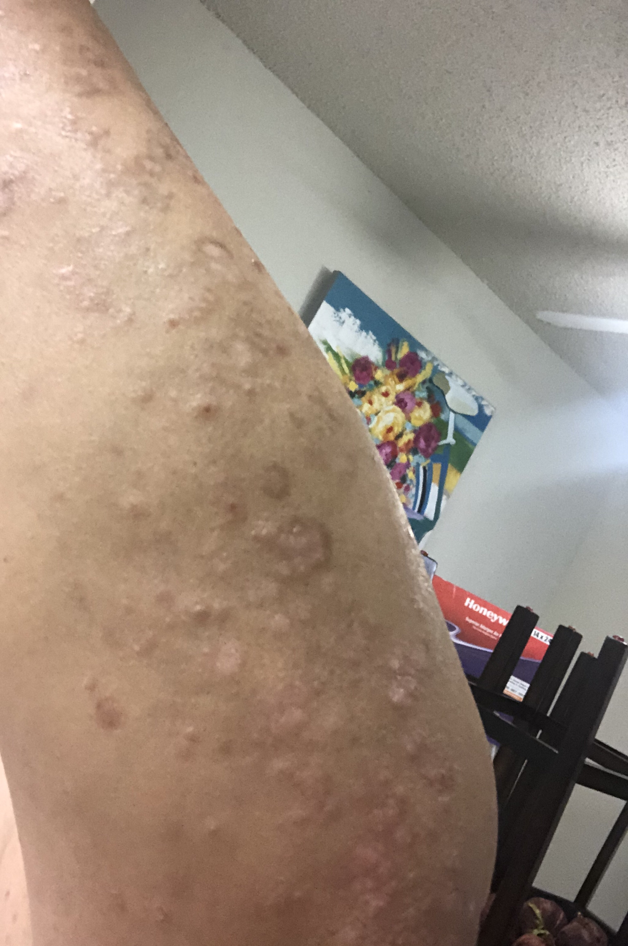 Will the scars ever disappear? : Psoriasis