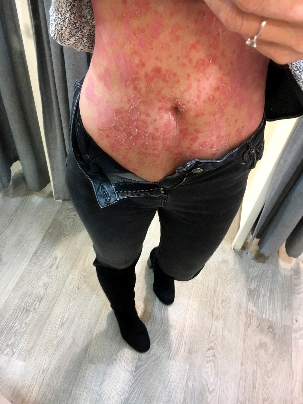 Woman plagued by agonising psoriasis for 35 years cures ...