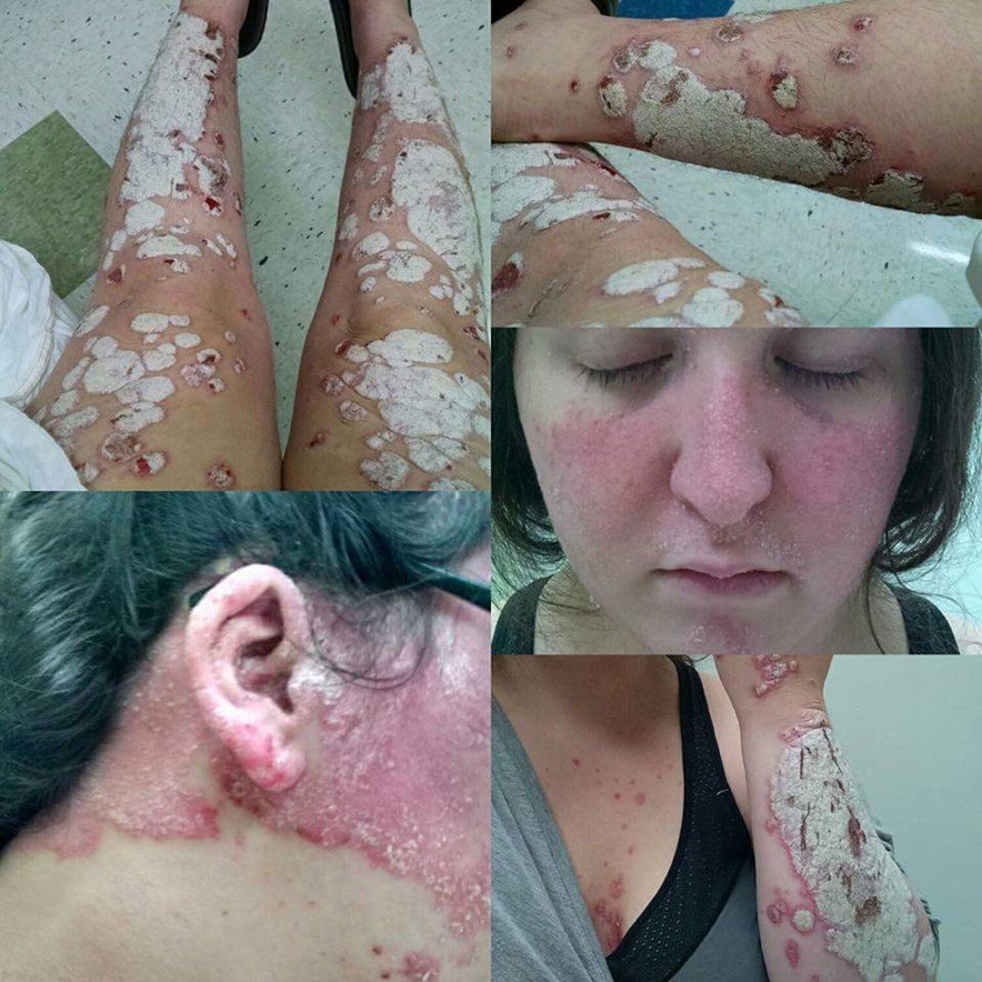 Womans psoriasis one of worst cases docs have seen, scaly plaques ...