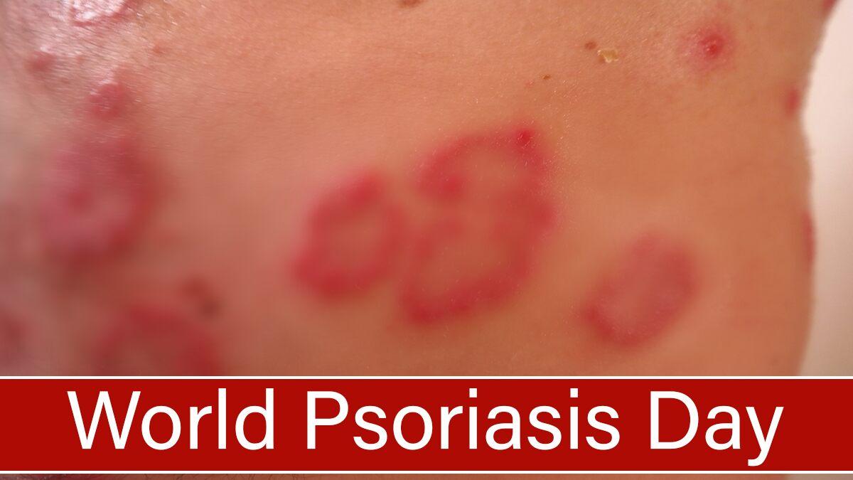World Psoriasis Day 2020 Date, History &  Significance ...