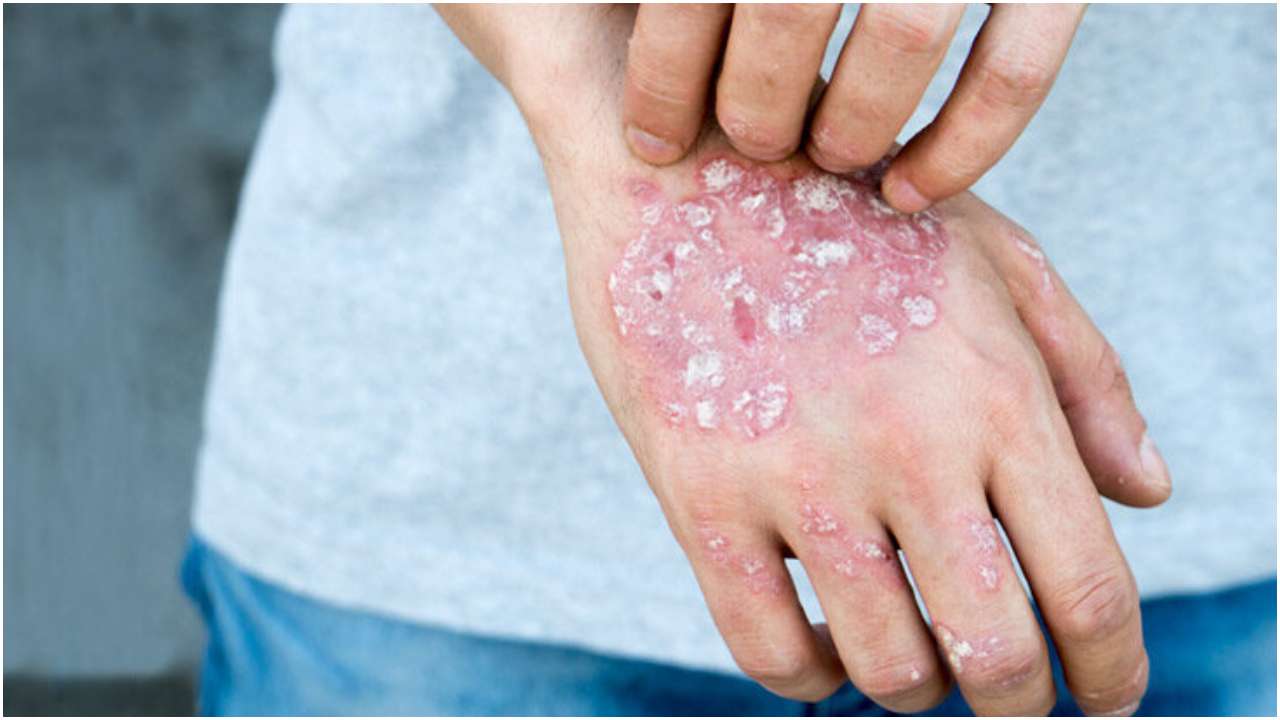 World Psoriasis Day: Know all about symptoms, causes, cure for the ...