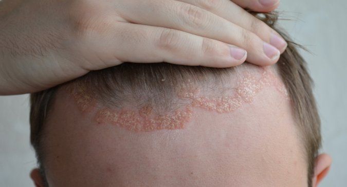 World Psoriasis Day, October 29: Try these home remedies ...